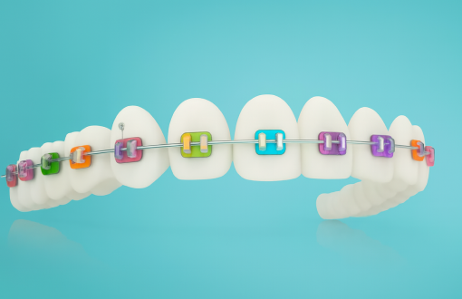 Full-Coloured Braces