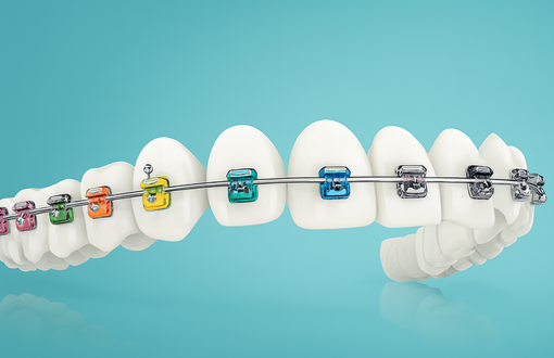 Metal Braces Colour Picker