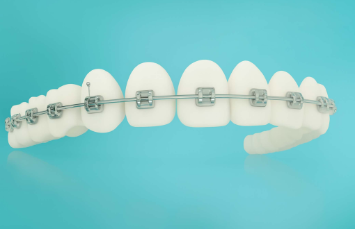 Self-Ligating Braces