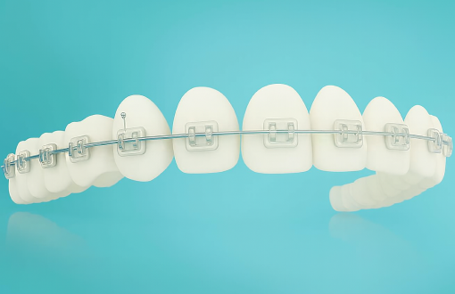 Self-Ligating Clear Braces