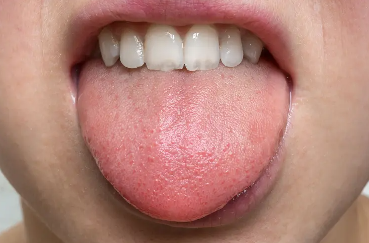 signs-and-symptoms-you-might-need-a-dental-filling